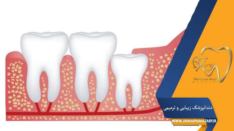 کشیدن دندان نهفته