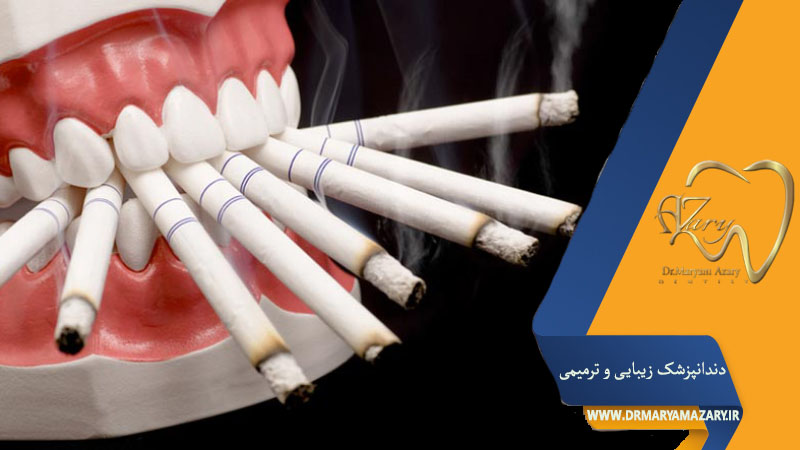 کشیدن سیگار بعد از ایمپلنت دندان