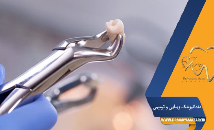 مراحل کشیدن دندان عقل بدون جراحی