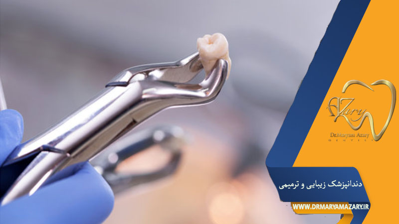 مراحل کشیدن دندان عقل بدون جراحی