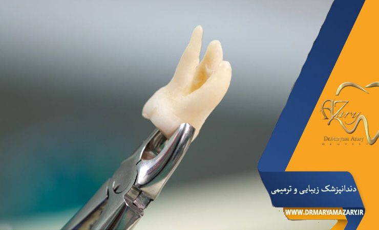 کشیدن دندان عقل بدون جراحی