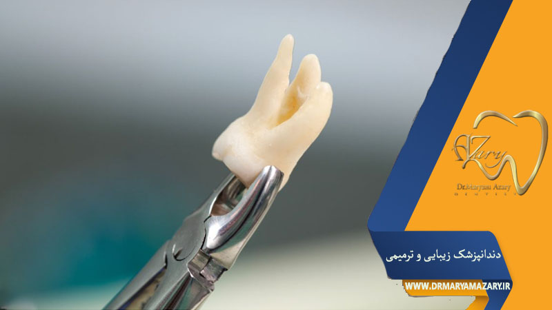 کشیدن دندان عقل بدون جراحی