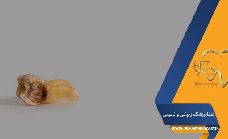 کشیدن دندان عفونی