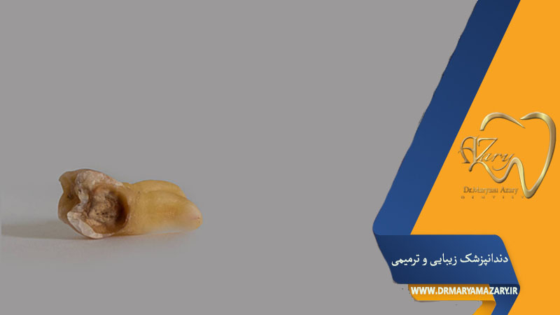 کشیدن دندان عفونی