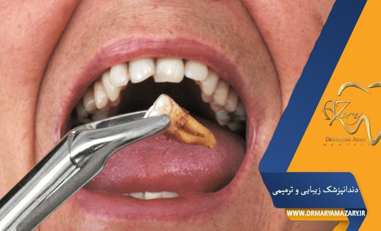 کشیدن دندان عصبکشی شده عفونی