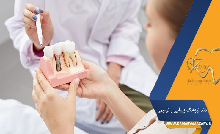 کبودی صورت بعد از ایمپلنت