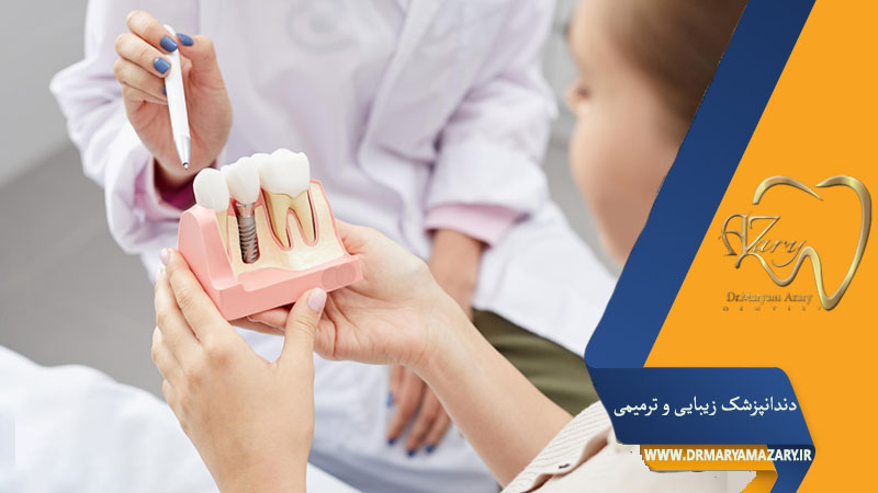 کبودی صورت بعد از ایمپلنت