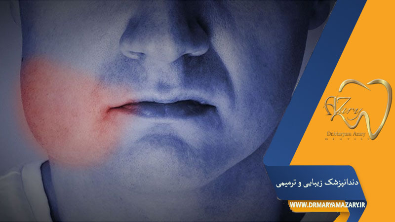 کاهش ورم صورت بعد از جراحی دندان