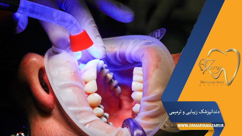 کامپوزیت کردن دندان