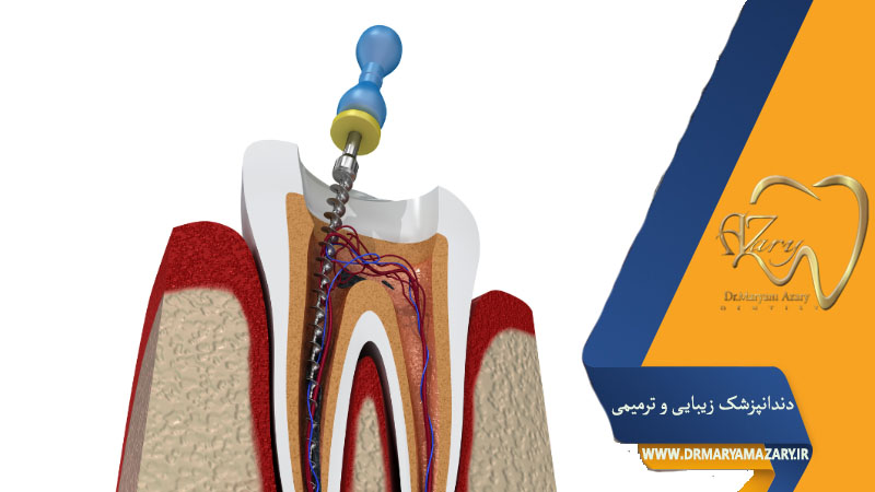 کانال دندان چیست