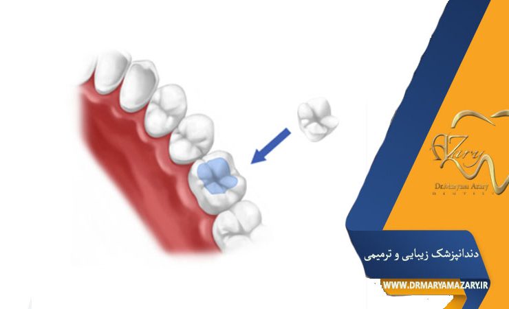 کامپوزیت روی دندان عصب‌کشی‌شده