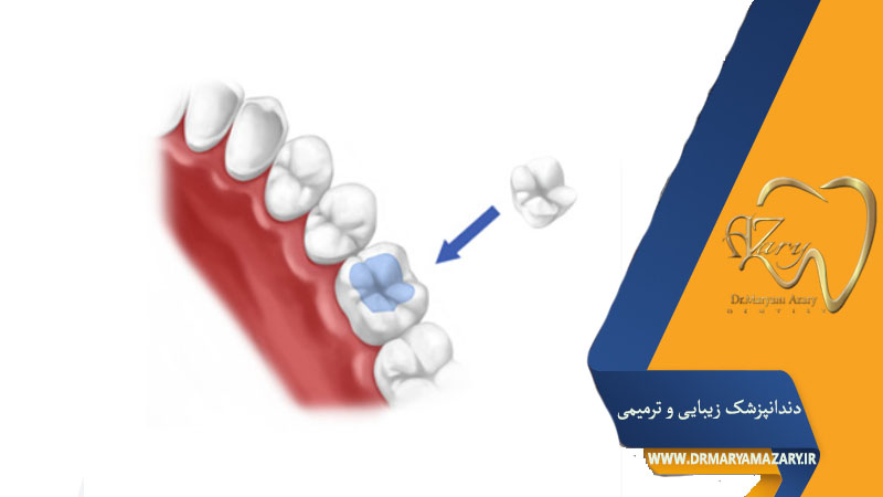 کامپوزیت روی دندان عصب‌کشی‌شده
