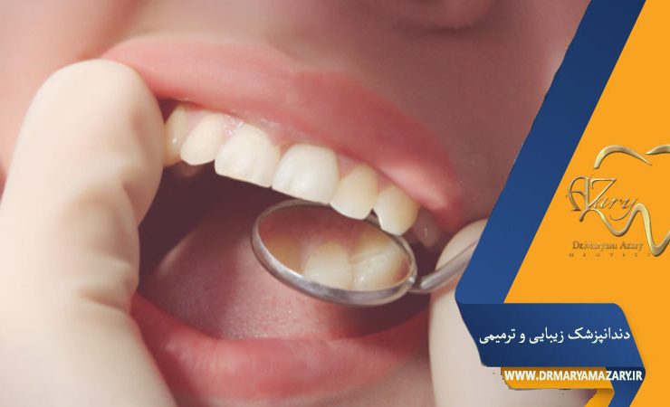 کامپوزیت دندانهای نامرتب