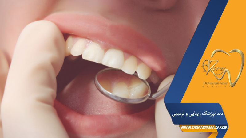 کامپوزیت دندان‌های نامرتب