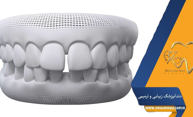 همه چیز درباره کامپوزیت دندانهای فاصلهدار