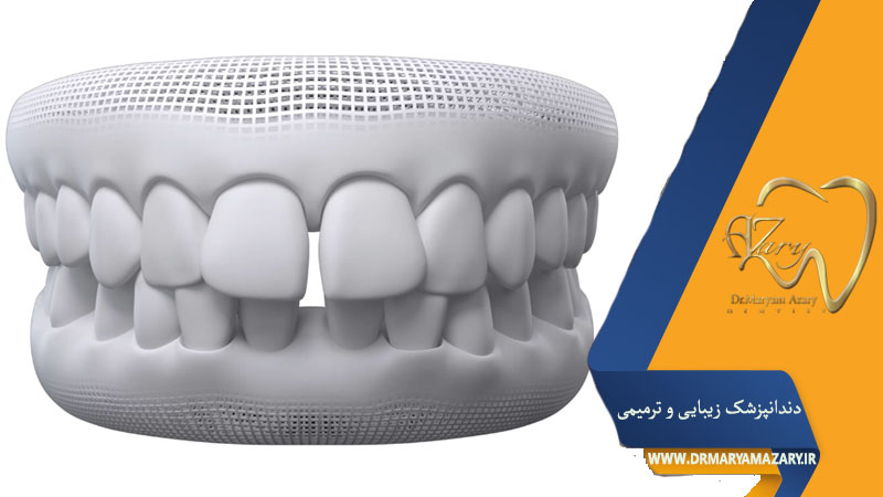 همه چیز درباره کامپوزیت دندان‌های فاصله‌دار