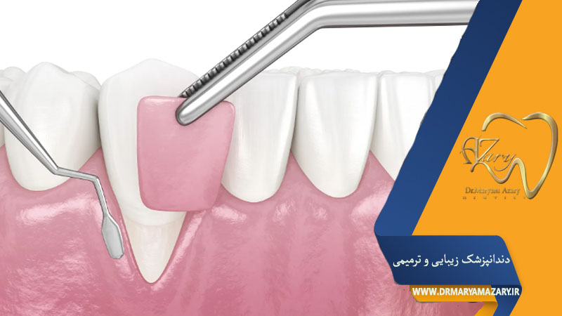 کاشت لثه مصنوعی