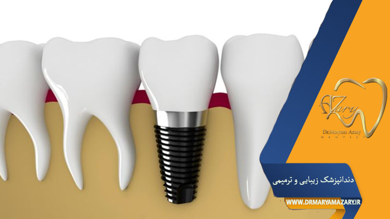 کاشت دندان دائمی