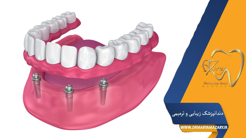 کاشت دندان مصنوعی ثابت