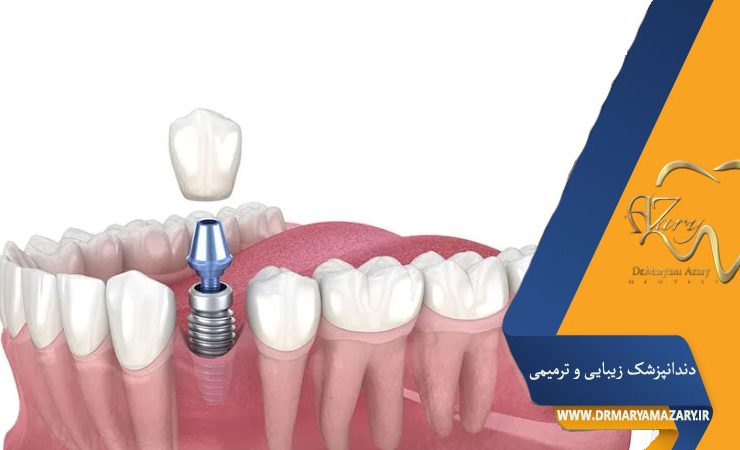 کاشت دندان نیش