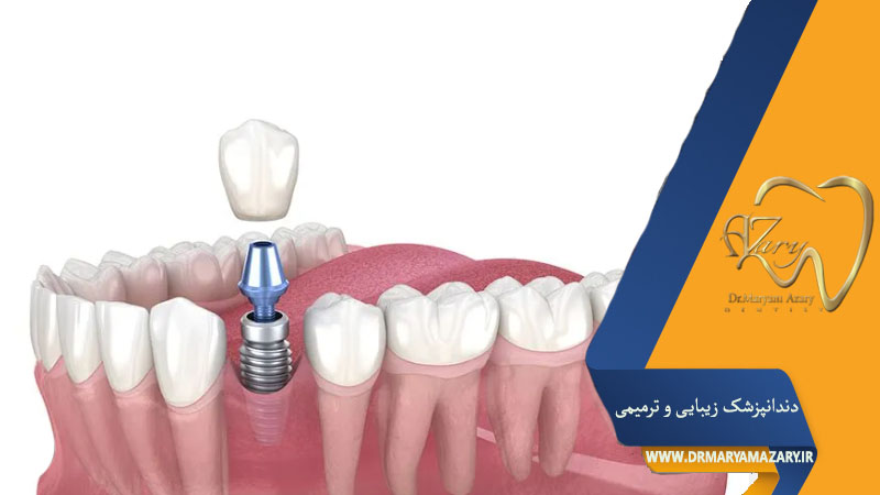 کاشت دندان نیش