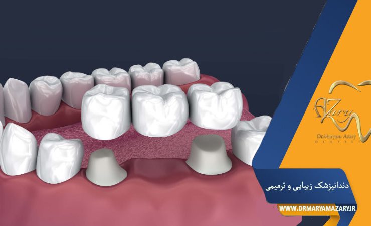 کاشت دندان به روش بریج