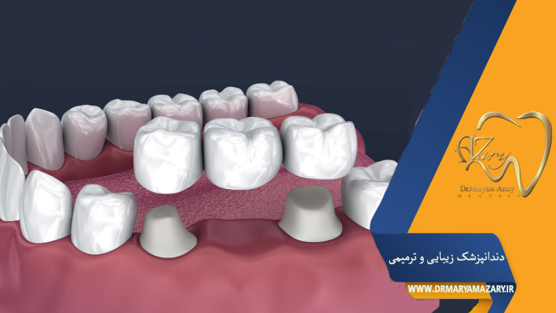 کاشت دندان به روش بریج
