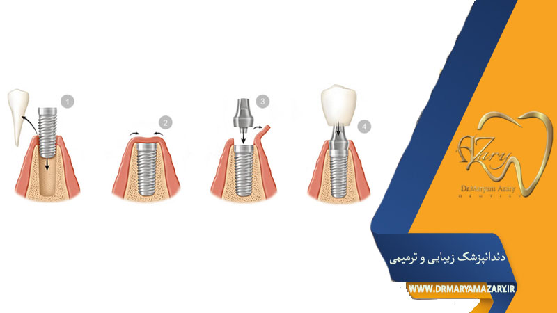 مراحل کاشت دندان به روش ایمپلنت