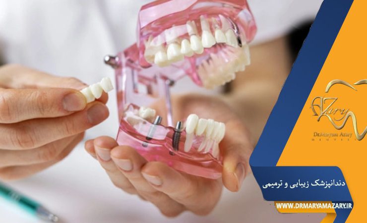 کاشت ایمپلنت به روش پانچ