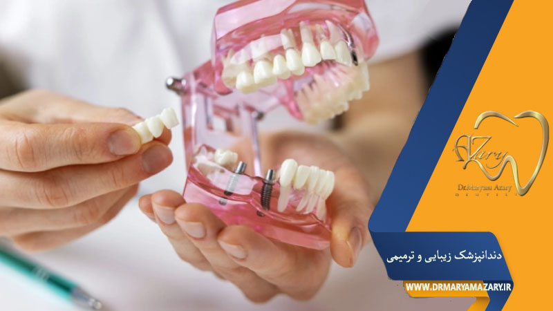 کاشت ایمپلنت به روش پانچ