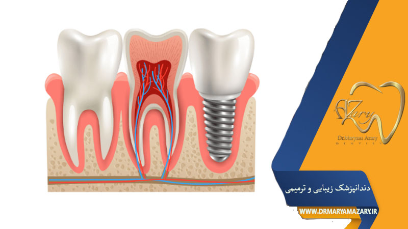کاشت دندان روی ریشه