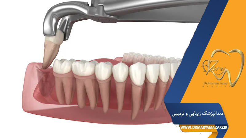 اقدامات لازم بعد از کشیدن دندان عقل