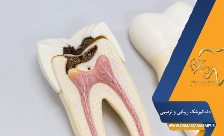 بعد از عصب‌کشی دندان
