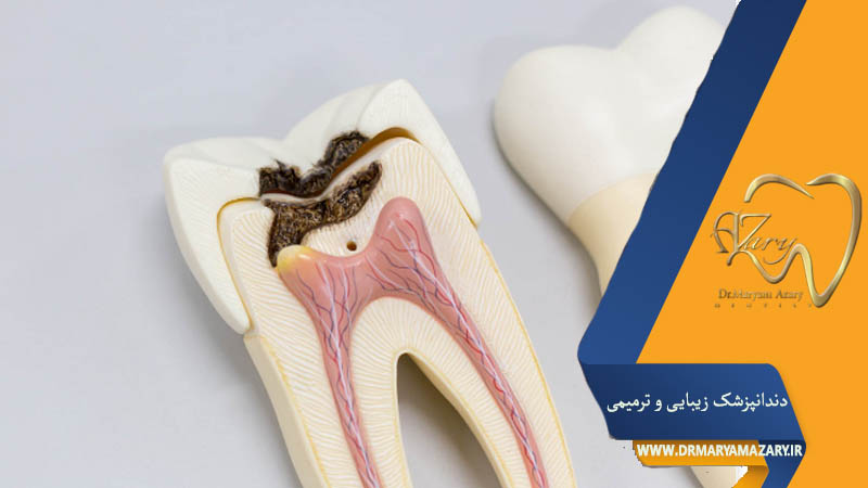 بعد از عصب‌کشی دندان