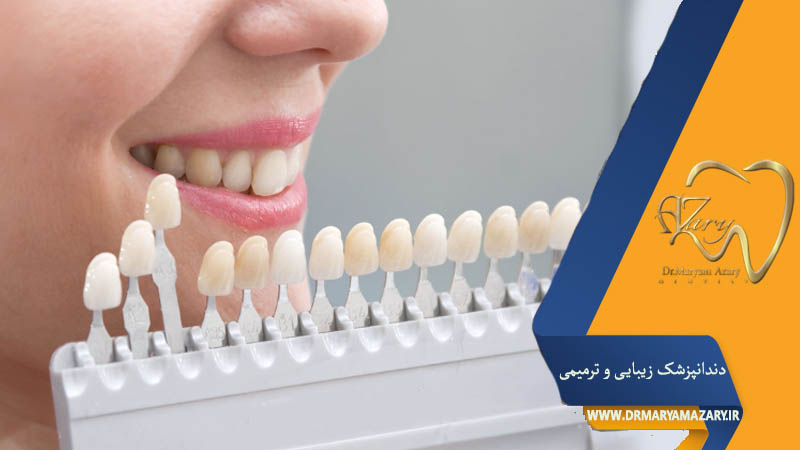 کاربرد لمینت دندان