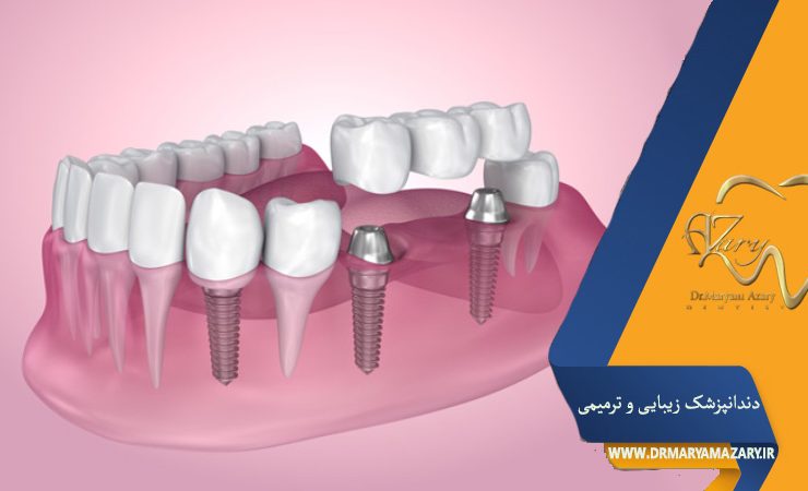 ایمپلنت چند دندان