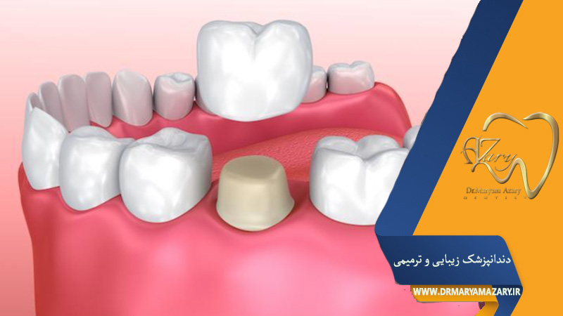 چسب موقت روکش دندان