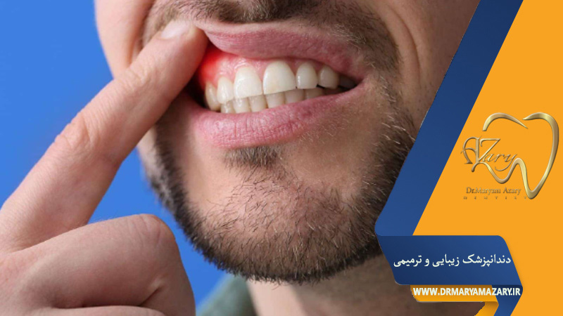 درمان چرک لثه