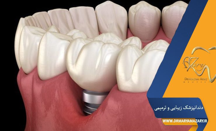 پیوند لثه قبل از ایمپلنت