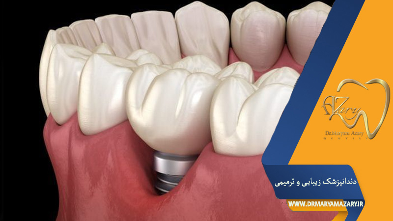 پیوند لثه قبل از ایمپلنت