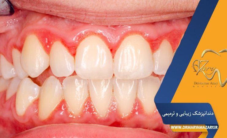 علائم پیوره لثه