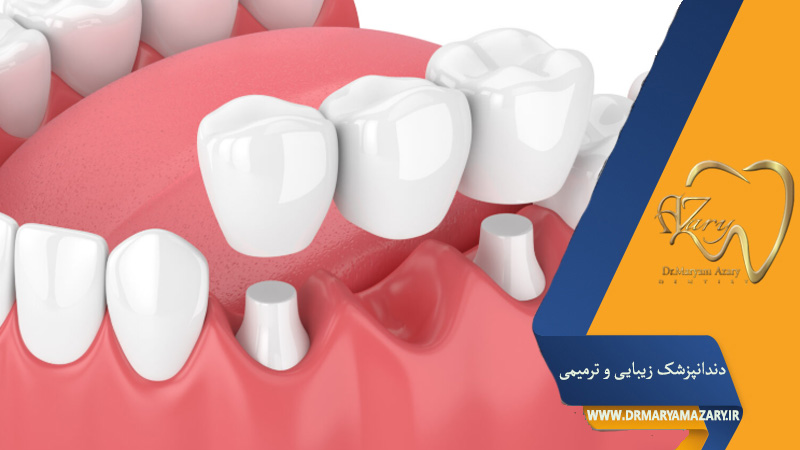 پونتیک دندان چیست