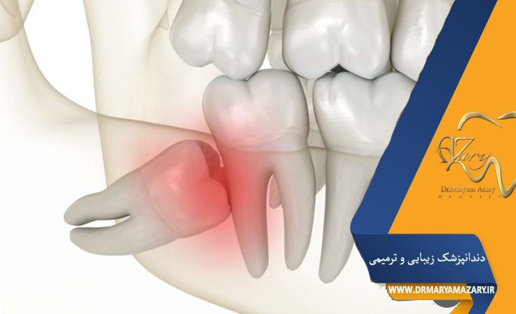 عفونت دندان عقل