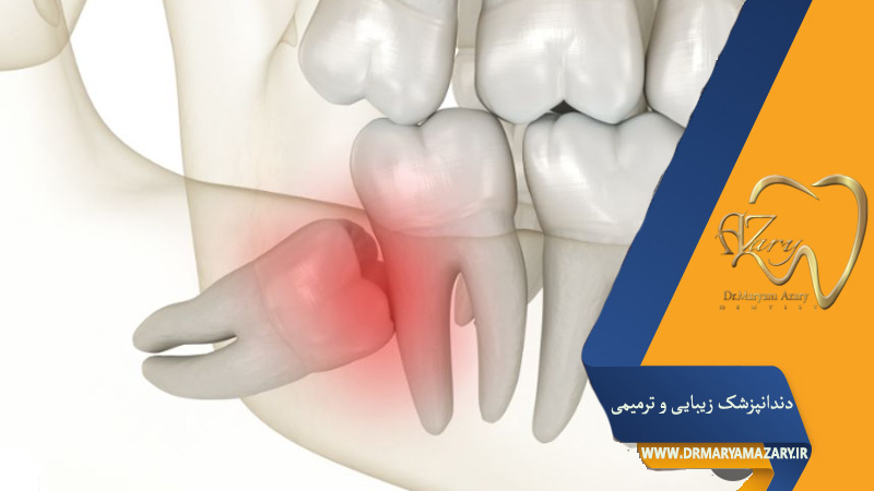 عفونت دندان عقل