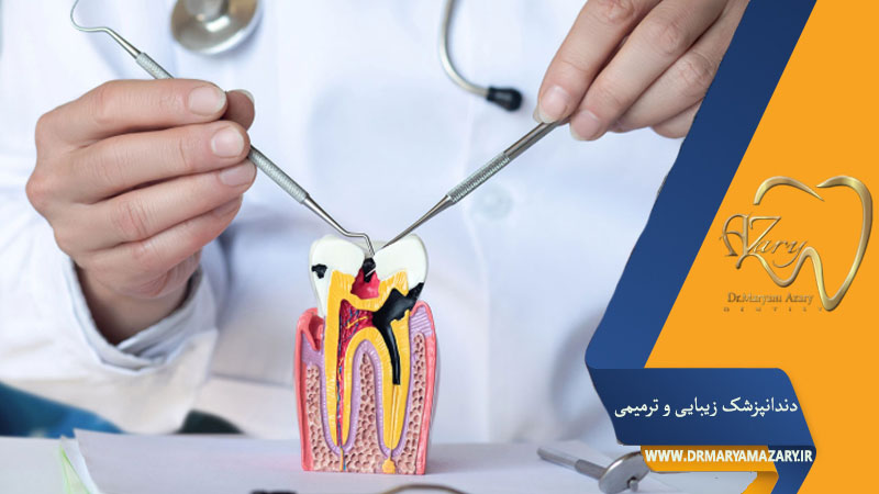 چرک کردن دندان عصب کشی شده