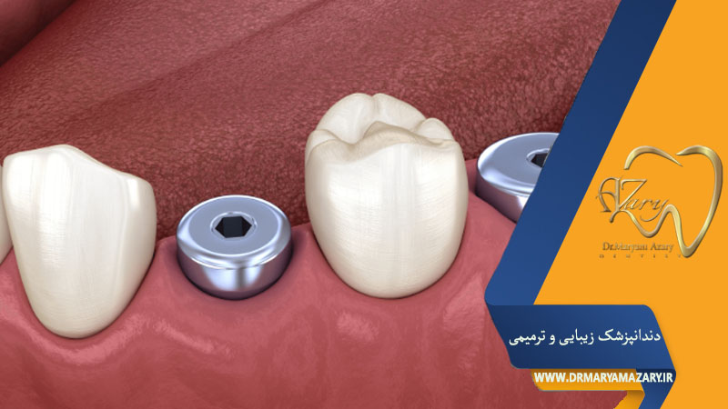 پیچ موقت ایمپلنت