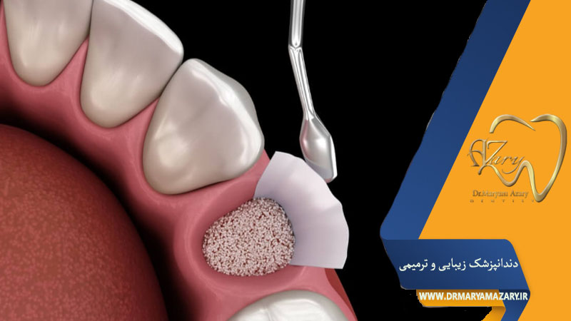 پودر استخوان دندان چیست