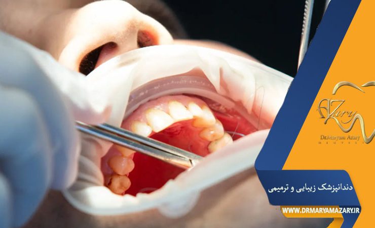پیوند لثه درد دارد