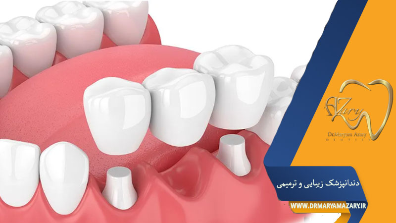 پل دندانی یا بریج