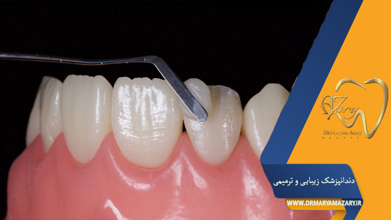 علت پوسته شدن کامپوزیت دندان